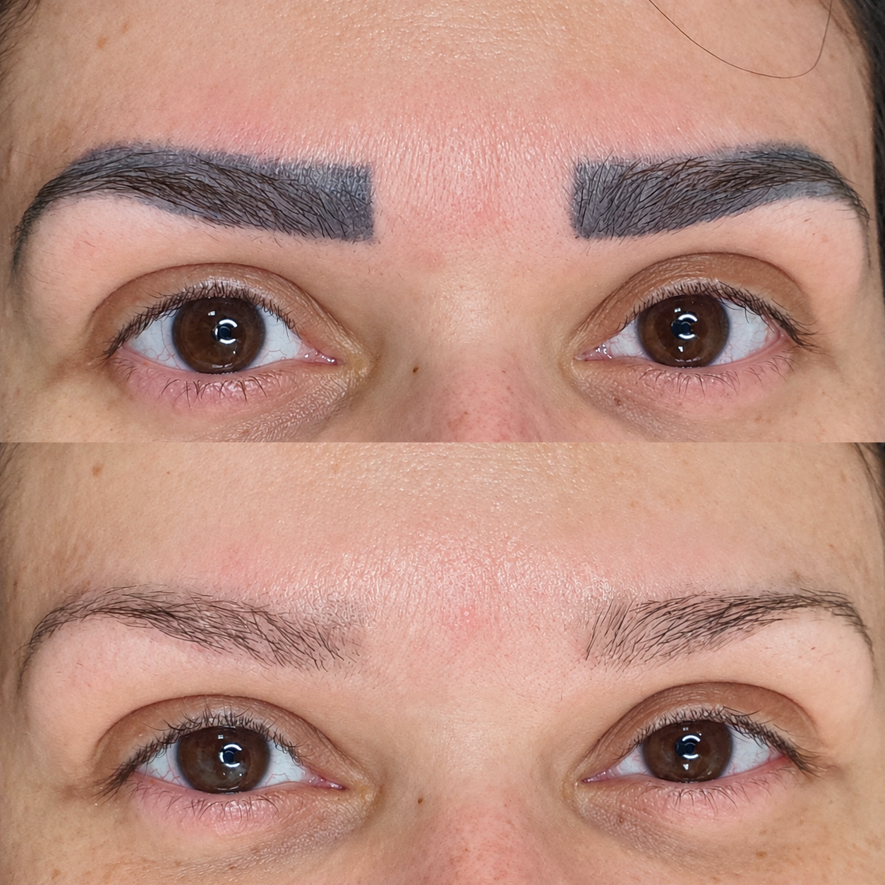 Comparação de remoção de micropigmentação: antes acima e depois abaixo
